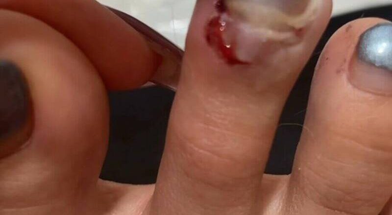 女骑YouBike被狗咬断脚趾甲 控饲主赔偿无诚意决提告